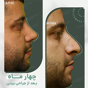 جراح-بینی-گوشتی-در-تهران